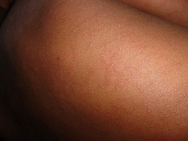 Одним из симптомов кори является характерная сыпь на коже